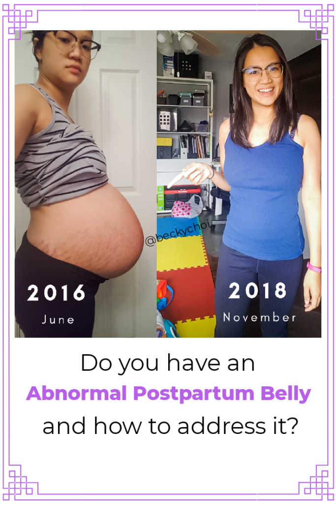 abnormal Postpartum belly