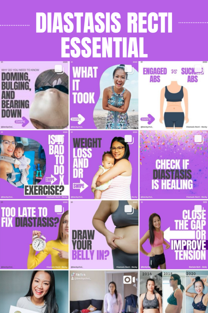 diastasis recti essentials