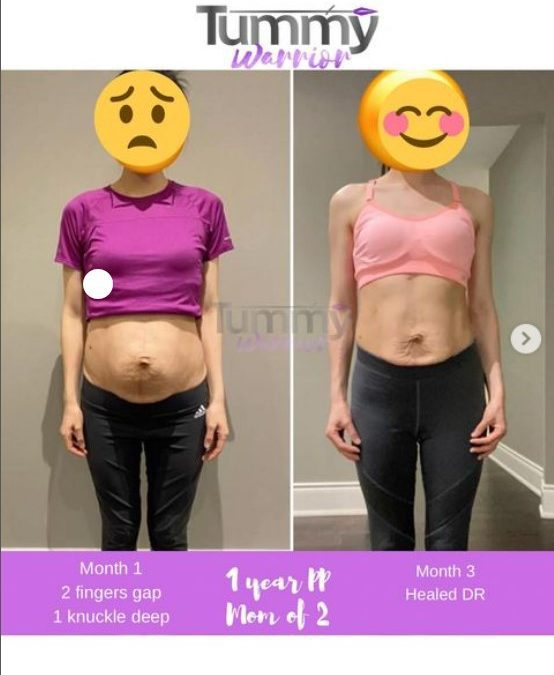 Severe Diastasis Recti (2 kids 10 yrs apart), vs 1 month post op